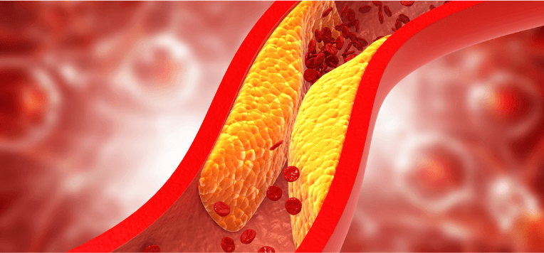Colesterolo alto: alimentazione e integrazione